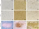 Investigadores de la REEM encuentran un posible papel de los astrocitos activados en la progresión de la EM